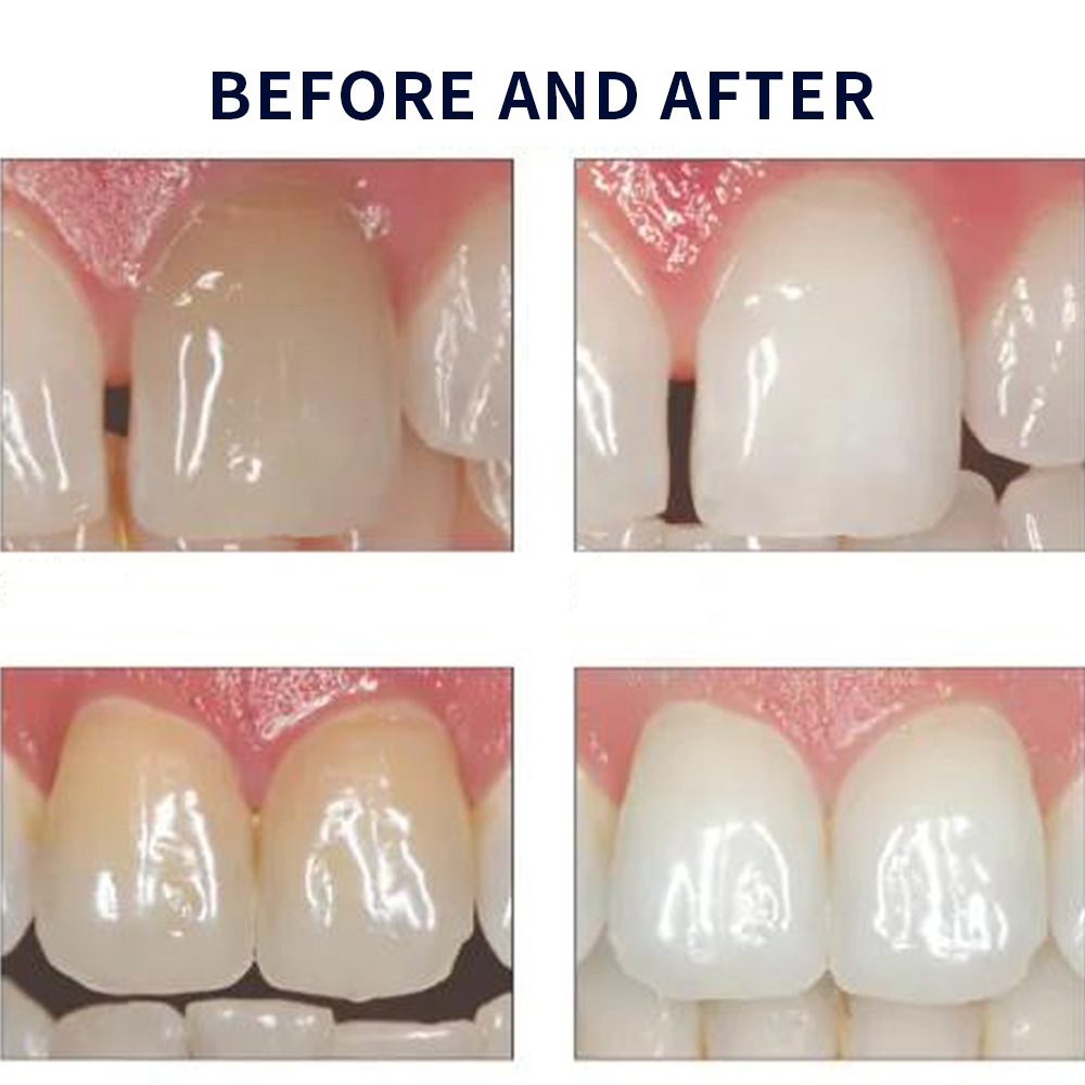 Opalescence Whitening 20% PF 2 - огляд і ціна Teeth Whitening Levels