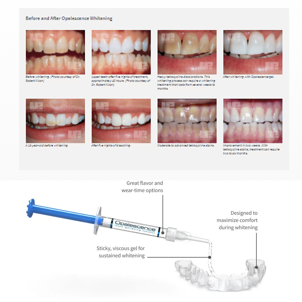 Opalescence Whitening 20% PF 2 - огляд і ціна Teeth Whitening Levels