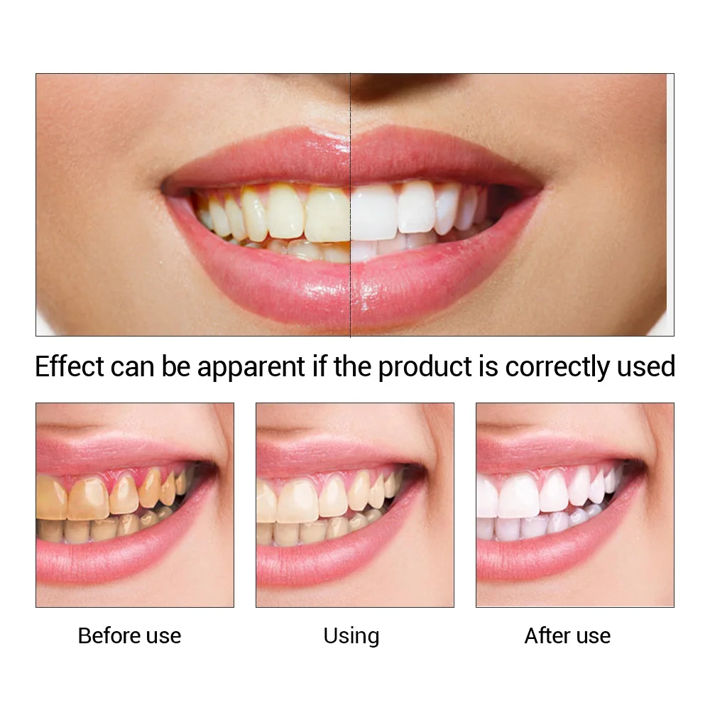 FTEENPLY Teeth Whitening Essen - огляд і ціна Teeth Whitening Essence